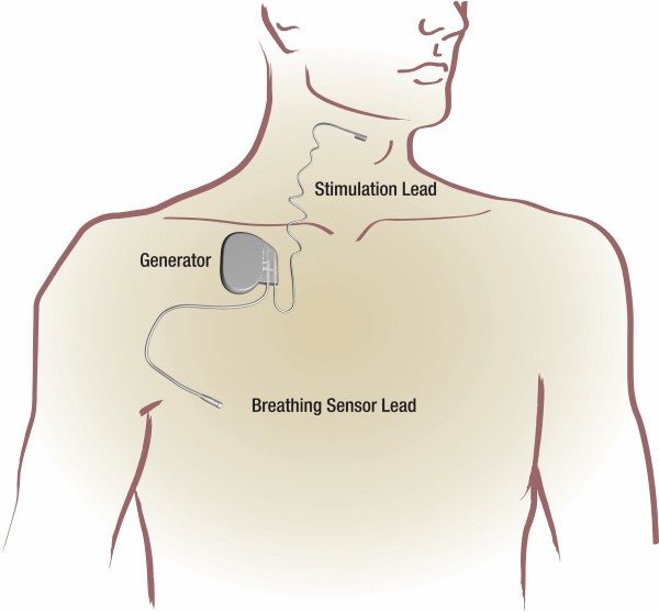 CPap Alternatives - Inspire Therapy graphic showing the Stimulation Lead, Generator, and Breathing Sensor Load.